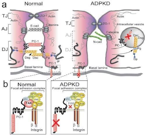 ADhesion problem PKD1 Mutation (Polycystin-1) 1.