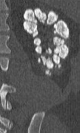 finding on radiograph Normal renal function Nephrolithiasis 1. Dilated (ectatic) 2. Collecting ducts 3.