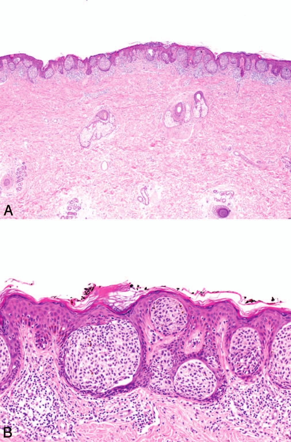 Figure 8. The nested variant of melanoma. These lesions are characterized by a predominantly nested pattern, imparting a resemblance to junctional nevi on low-power examination (A).