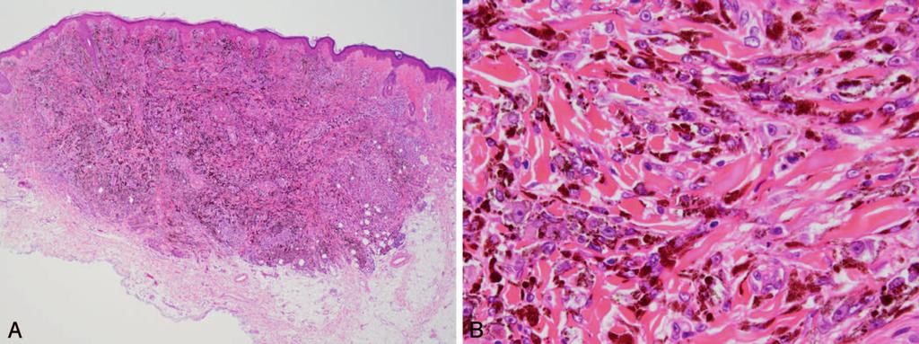 Figure 10. An example of a pigmented epithelioid melanocytoma. At low-power examination the lesion is well circumscribed, and the heavy pigmentation is obvious.