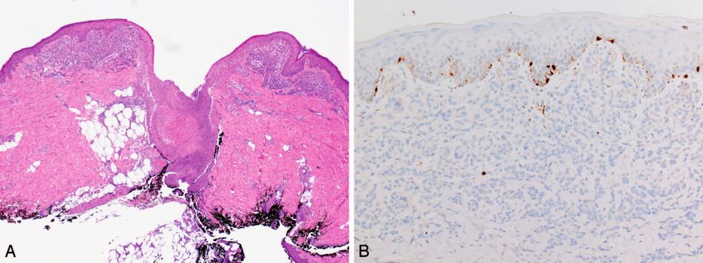 Figure 11. This previously punch-biopsied lesion displayed bland architectural features but cytologic atypia (A). There was complete loss of immunohistochemical staining for p16 (B).