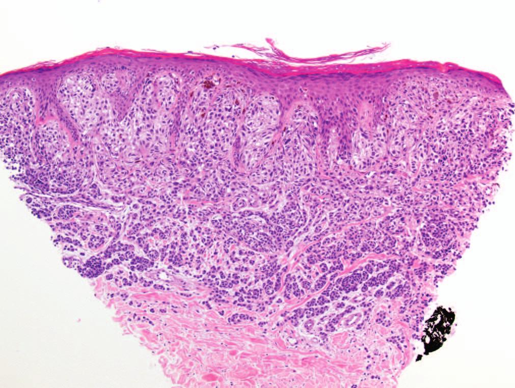 Figure 12. The difficulties of partial biopsies.