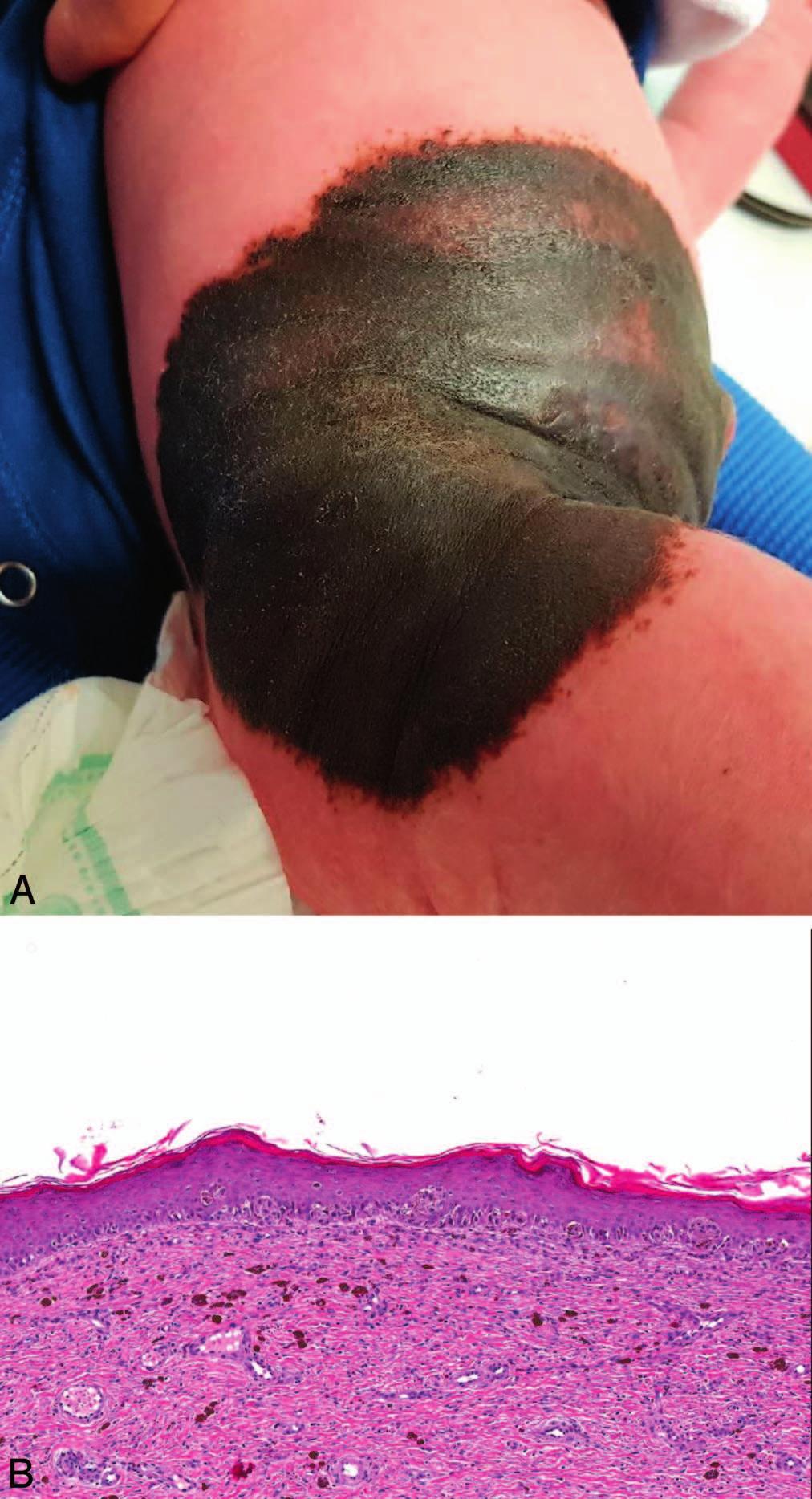 Figure 3. This giant congenital nevus (A) shows atypia of the junctional component (B) that could be construed as melanoma in situ in an adult patient.