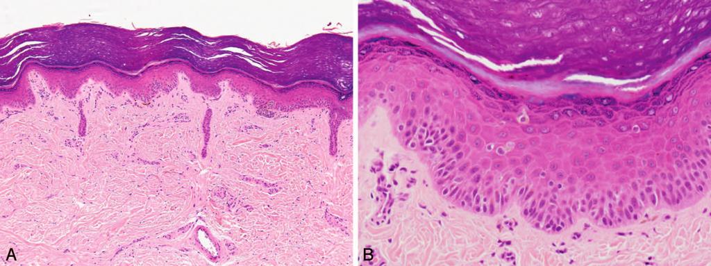 Figure 4. An acral nevus, characterized by both nests and single cells arranged along the junction (A), with occasional suprabasal scatter (B).