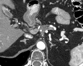 DVH Tumor/LN Right Kidney Liver Spinal