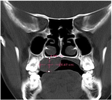 2: CT scan picture showing vertical extent of swelling with intact
