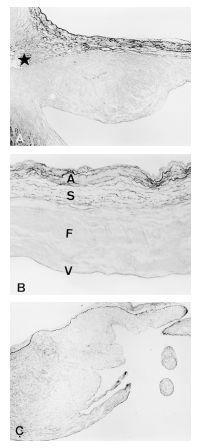 Figure 8 Histologic sections of normal mitral valve. (A) Annulus and basal third of the leaflet. (B) Middle third of the leaflet. (C)Distal third of the leaflet.