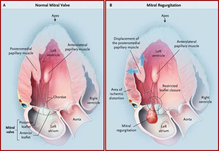 Nowadays MS is not that common disease but MR is the second most common valvular disease in Europe. In Figure.10 you can see the difference between a normal MV and a MV with regurgitation.