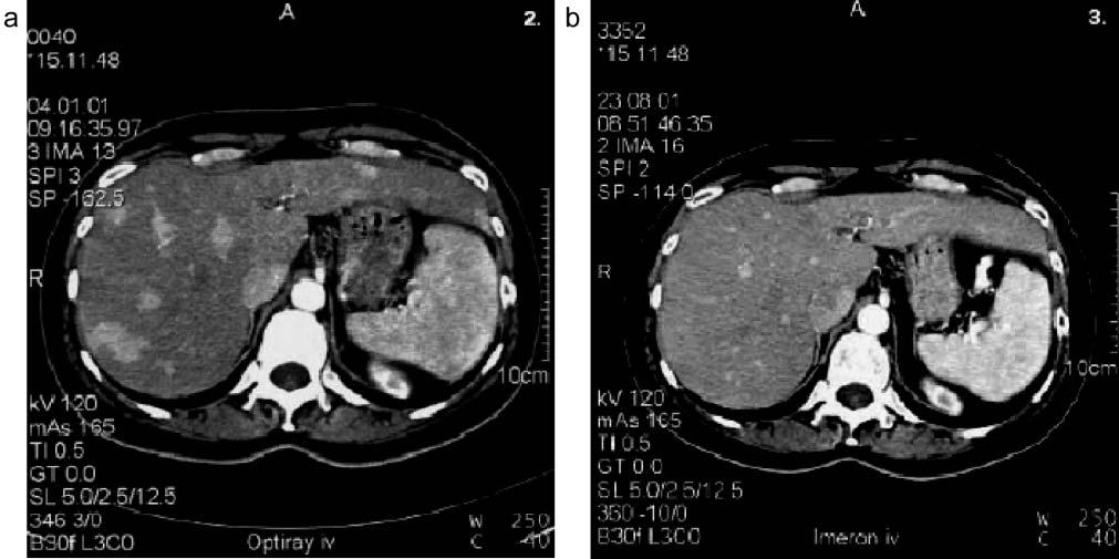 Planar scintigraphic scan of the abdomen 46 hours after the injection of 200 mci 90 Y-DOTATOC and 3 mci 111 In-DOTATOC in the same patient shown in Figure 1a.