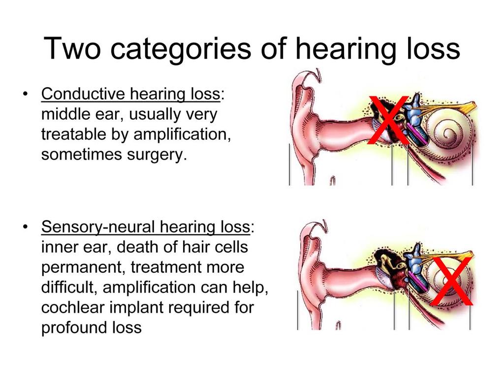 When middle ear function is degraded, it results in a conductive hearing loss. A common cause is otosclerosis in which bony growth impedes the movement of the middle ear ossicles.
