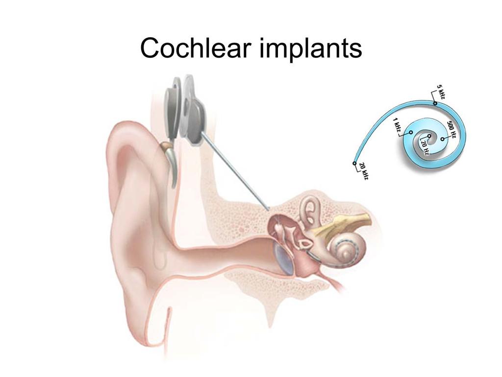 The tonotopic organization of the cochlea, and the selective innervation of that sensory epithelium, is taken advantage of with the cochlear implant.