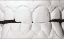 Anterior tooth wear can lead to a decrease in tooth length, which results in the loss of canine protected occlusion.