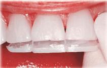 mm. Tooth aesthetics are variable and should be considered on an individual basis. Tooth length may be increased or decreased with orthodontics or restoratively.