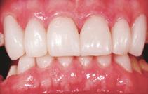 To create a longer tooth without increasing incisal edge length, orthodontic intrusion followed by restorative addition can be completed in combination with crown lengthening.