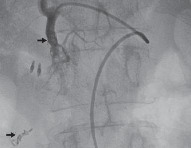 Guidewire b Angiography before embolization Iliac a Vascular supply to stomach Fig. 1 Typical sandwich embolization in a patient with bleeding from a postbulbar duodenal ulcer at endoscopy.