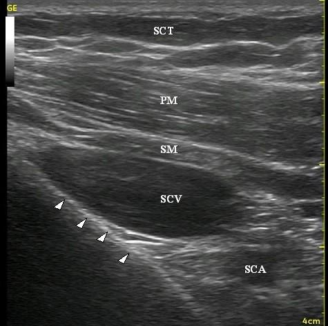 (a) (b) Figure 2. Ultrasonographic image obtained at the infraclavicular level. (a) Blank image. (b) Labelled image.