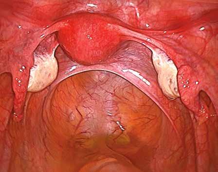 25 clinical review Update Pathology Endometriosis is essentially ectopic endometrium, microscopically similar to eutopic endometrium, in that it contains endometrial glands and stroma.