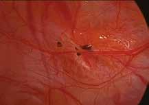 At least two or three of these findings are required to confirm a diagnosis of More recently, nerve fibres have been found in the curettage biopsies of eutopic endometrium of women with