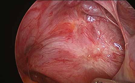 Consequently, the organs commonly affected by endometriosis include the peritoneum of the pelvic side walls, anterior cul-de-sac (overlying the bladder) and posterior cul-de-sac (Pouch of Douglas;