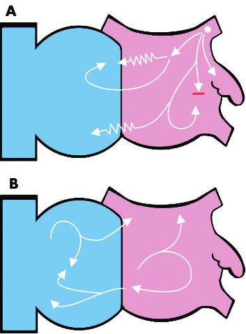Figure 1 A shemati view of the interior surfae of the right (blue) and left (pink) atria. The white arrows represent wavefronts of eletrial depolarisation.