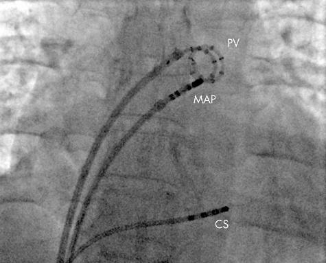 The mitral valve (MV), triuspid valve (TV), oronary sinus (CS), superior vena ava (SVC), inferior vena ava (IVC), and left (LAA) and right (RAA) atrial appendages are labelled.