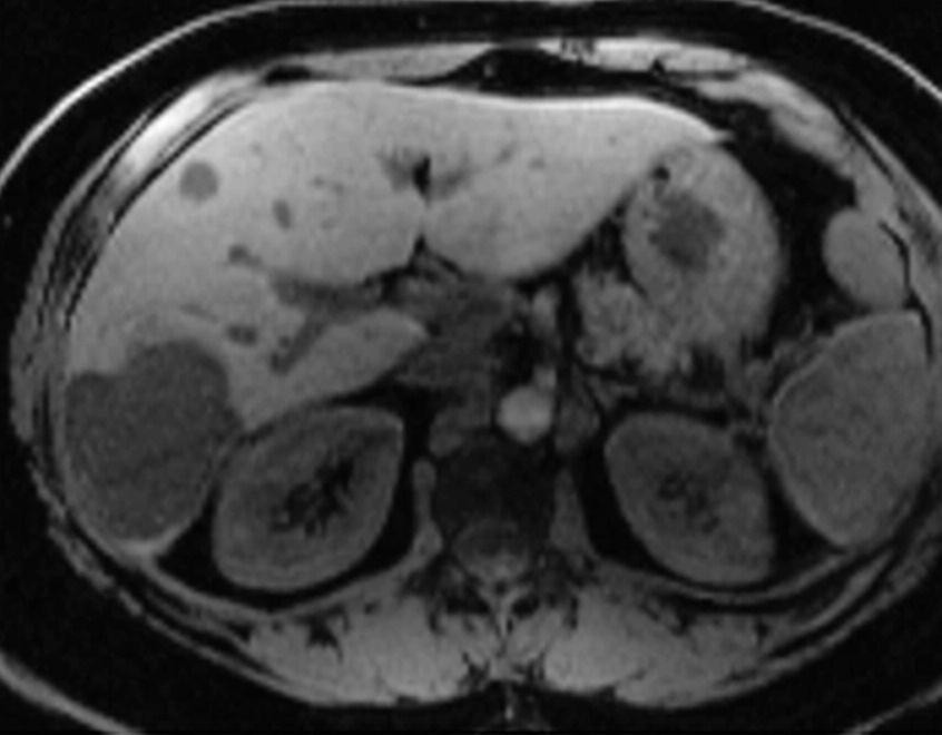 The equilibrium state of the liver occurs approximately 90-120 seconds after administration of contrast.
