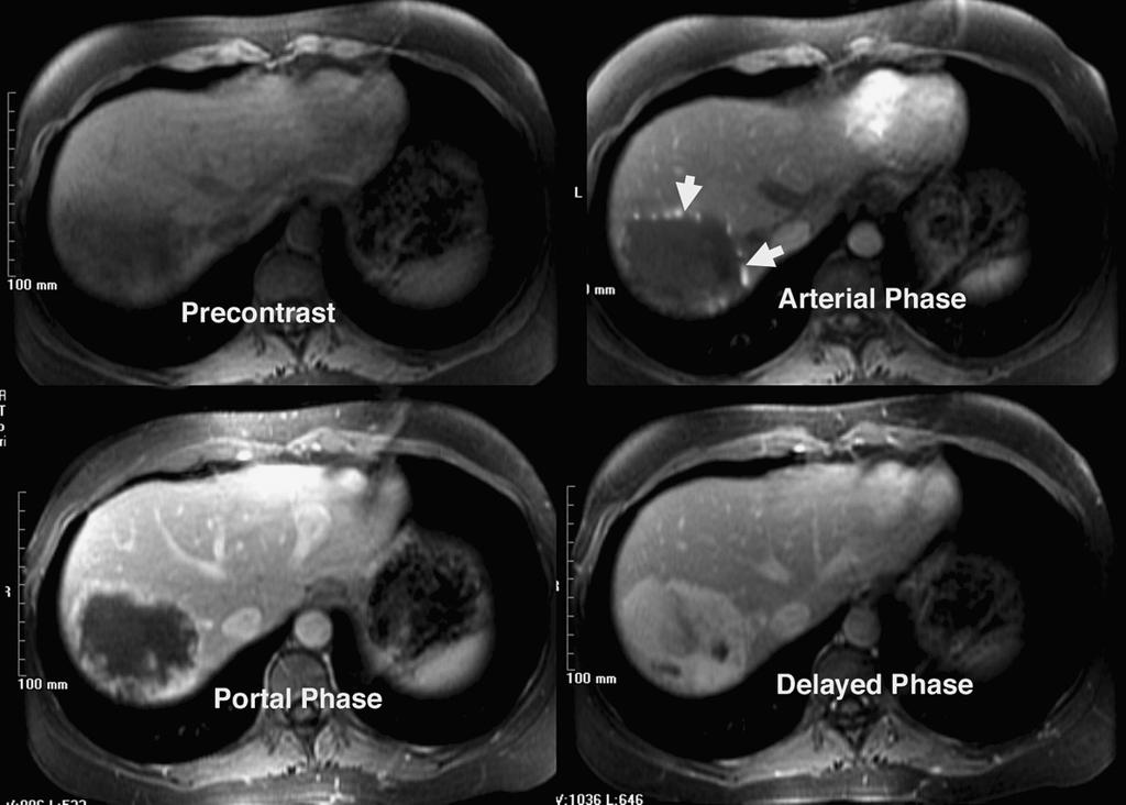 MRI OF THE HEPATOBILIARY SYSTEM Chapter Four 57 MRI FINDINGS The liver is imaged to detect and characterize either focal diseases or diffuse processes.