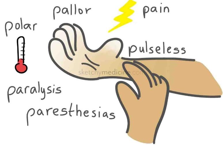 5 P's signs of acute ischemia Pallor Pain