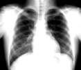 What are some examples of the diseases or conditions that show obstructed airways? 1.