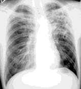 This would include diseases like Sarcoidosis, Tuberculosis, and Pneumonia. 2. Some restrictive patterns show up on PFT s due to disorders outside the lungs themselves.