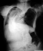 Fluid outside the lungs, but inside the ribcage called a Pleural Effusion will make it very difficult for the lungs to expand fully. Something easy to overlook is a normal pregnancy.