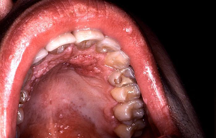 The HPV-associated warts are commonly seen in the anogenital areas, but oral involvement may also occur.