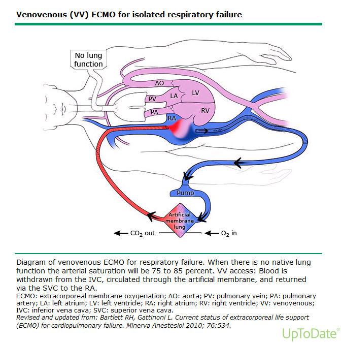CVVHD Ability to ventilate