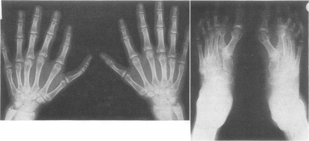 Radiograph of the hands of.4. FG. 2.