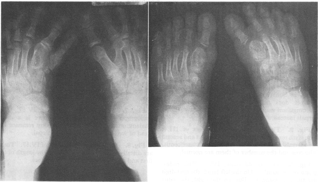 Hereditary index finger polydactyly 473 FG. 5.