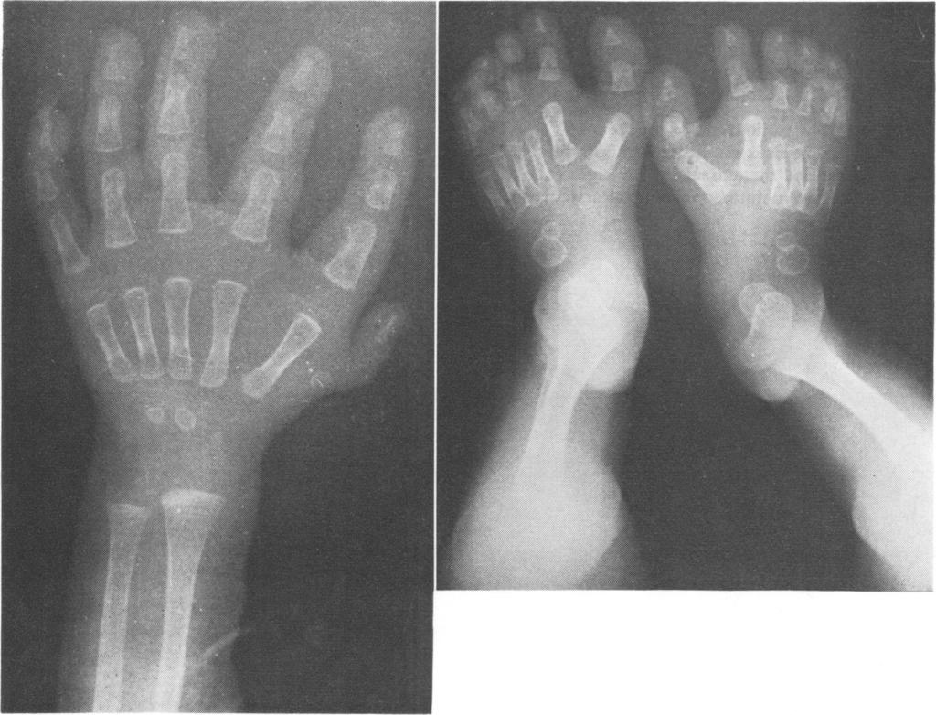 Radiograph of the feet of V.14. _ 1.-'......; X FG. 7.