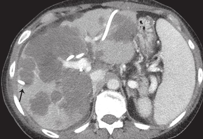 right PBD; (C) axial CT image demonstrates a left (arrowhead) and right (arrow) PBD traversing tumor tissue. PBD, percutaneous biliary drainage; CT, computed tomography.