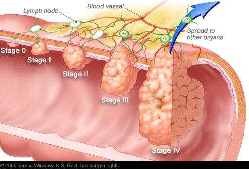 Staging is the attempt to assess the size of a tumor and its extent of involvement throughout the body.