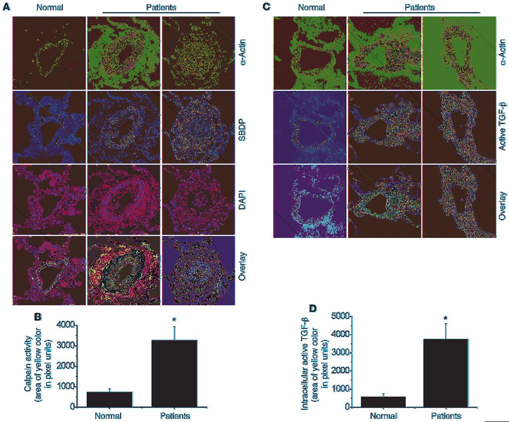 Figure 15 Levels of calpain activation and active TGF-β in smooth muscle cells of muscular pulmonary arteries of patients with pulmonary arterial hypertension.