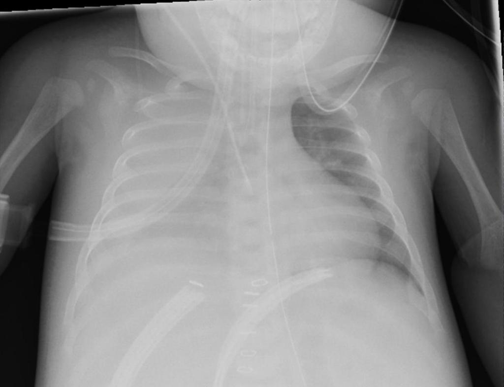 Images for this section: Fig. 1: Chest x-ray shows large right pleural effusion in a 7-month-old patient, weighing 6.