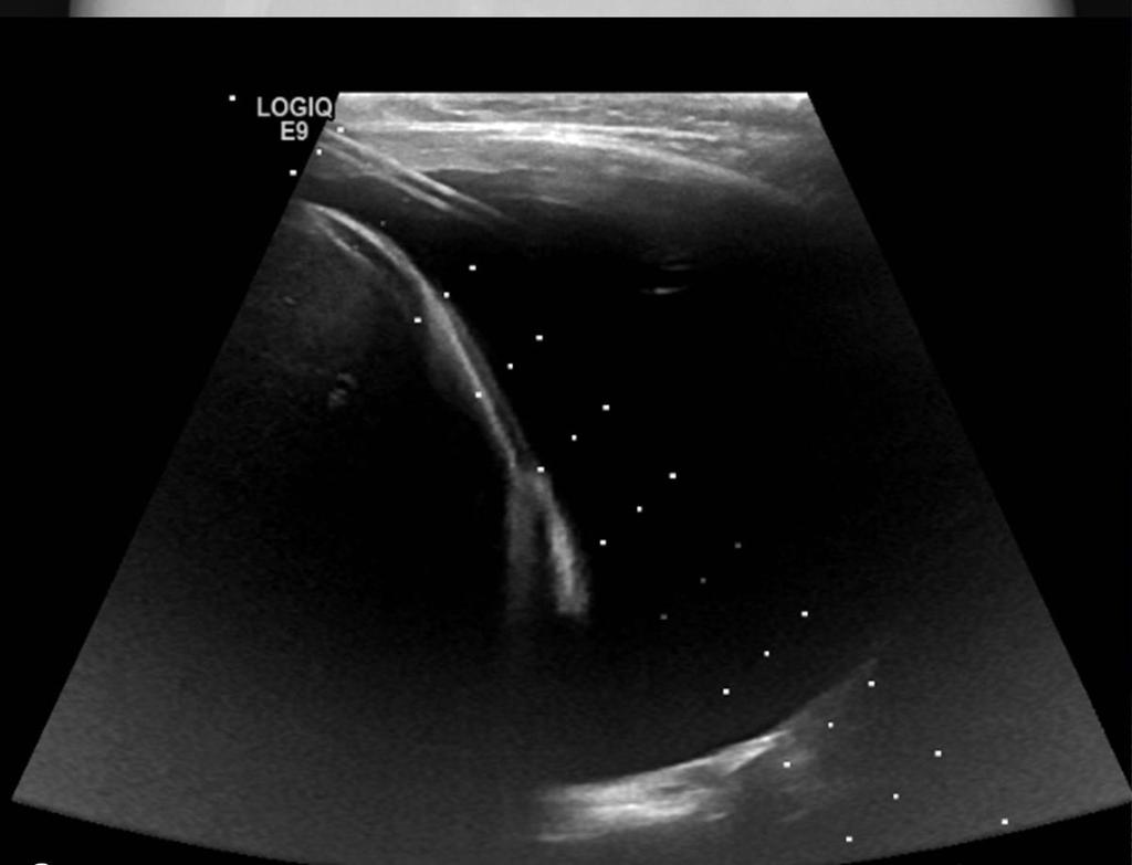 Fig. 3: Ultrasound confirmation of correct