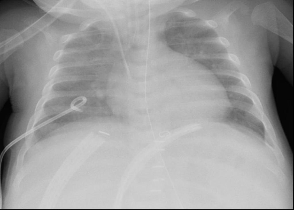 Fig. 4: Chest x-ray performed the day after the procedure; of note
