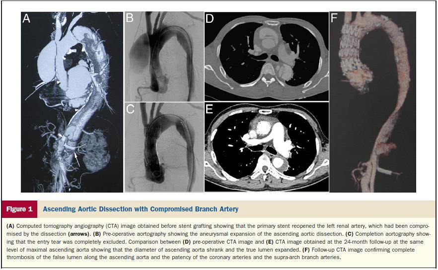 Emerging Therapy for the ascending Aorta Lu Q, et