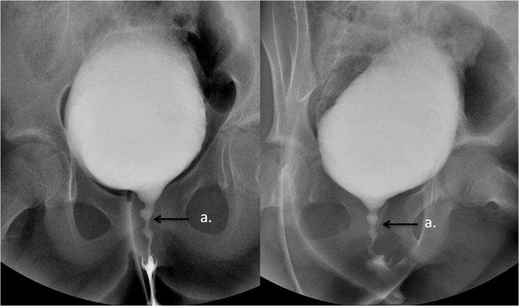 inguinal hernia containing urinary bladder (arrow b).