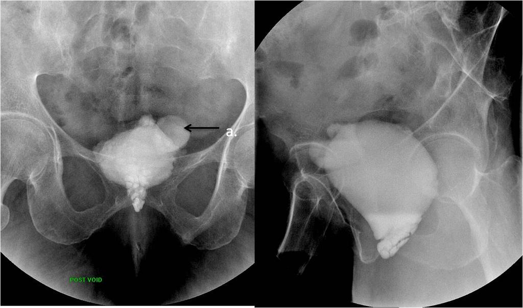 Figure 3: MCU study of a female child demonstrates corkscrew urethra (arrow a).