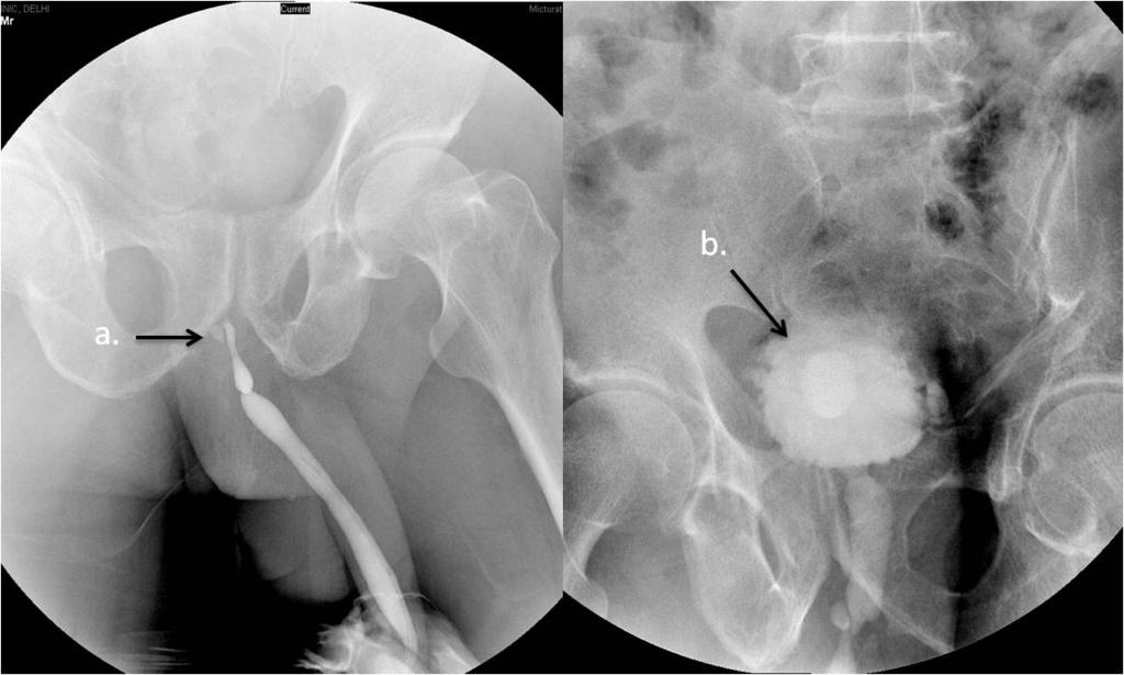 suggestive of posterior urethral valve, with prominent proximal urethra (arrow b) and presence of bladder