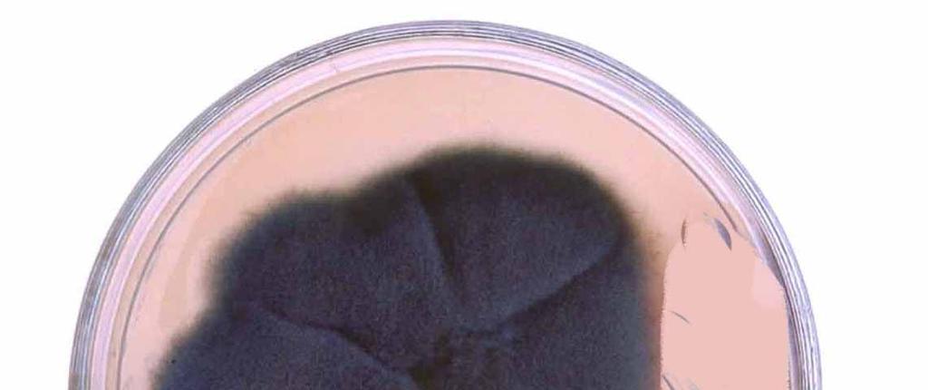 Photograph no.4: Sabouraud dextrose agar with growth of Fusarium solani Photograph no.5: Lactophenol cotton blue stain showing Fusarium solani (400x) Photograph no.