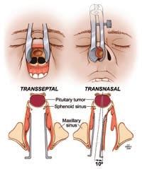 Transseptal Sublabial incision Nasal septum removed and replaced Postoperative nasal packing for 3-5 d John L. Atkinson, MD, and Charles F.