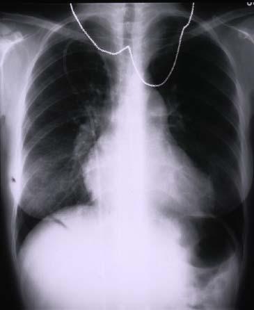 Central Pulmonary arterial