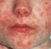 Common Diseases - Measles Airborne; Contact with respiratory secretions 10-12 Days Rash